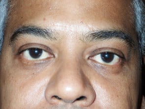 Lower Eyelid Cosmetic Transconjunctival Blepharoplasty and Lower Eyelid Bags Before and After Results Fort Lauderdale
